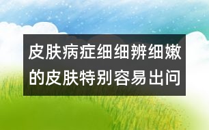 皮膚病癥細(xì)細(xì)辨：細(xì)嫩的皮膚特別容易出問(wèn)題